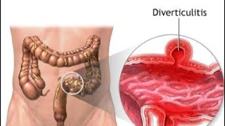 Diverticulitis  Causes Types Symptoms and Treatment [upl. by Wernsman819]