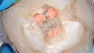 Obturation of Root Canal in Lower Molar amp live demo [upl. by Gittle22]