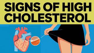 10 Common Signs of High CHOLESTEROL You SHOULD NOT Ignore  Healthy Living Podcast [upl. by Nospmoht340]