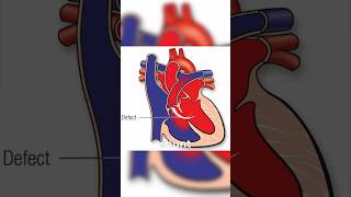 Eisenmenger Syndrome usmle [upl. by Photina]