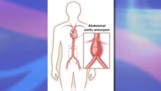 Risks and Benefits of Endovascular Abdominal Aortic Aneurysm Repair EVAR [upl. by Eidde]