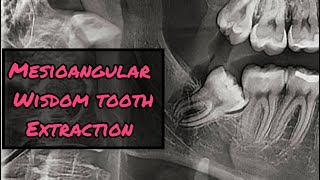 Mesioangular Wisdom Tooth Extraction StepbyStep [upl. by Rellia348]