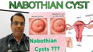 NABOTHIAN CYSTCAUSE  SYMPTOMS  HOMEOPATHIC MEDICINE [upl. by Ellehctim667]