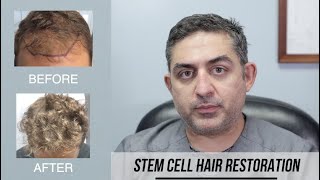 Stem Cell Hair Restoration Success Story [upl. by Cromwell633]