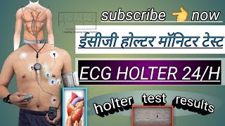 ecg holter monitor test  holter test results  holter monitor 24 hoursheart holter testviral [upl. by Yahiya642]