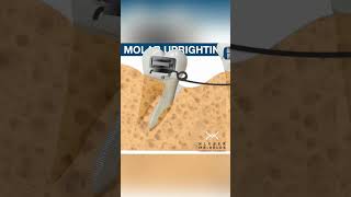 MOLAR UPRIGHTING  ORTHODONTIC TIPS Shorts [upl. by Ragde]