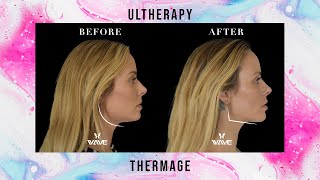 Ultherapy vs Thermage Non Surgical Facelift with Collagen Stimulation  Wave Plastic Surgery [upl. by Consalve172]