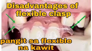 Disadvantage of flexible dentures Pustiso na Flexible DatuAmbasTv [upl. by Emerson362]