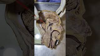 CEREBRO SPINAL FLUID  CIRCULATION  csf shorts anatomy shortsyoutubeindia shortsyoutube [upl. by Mika]