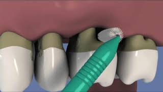 Brossette interdentaire et parodontite [upl. by Peck]