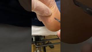 Expert Australian Podiatrist Removes Painful Corns with Precision [upl. by Kerwon]