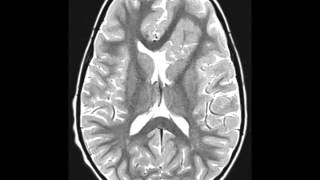 Cortical Dysplasia [upl. by Greenlee686]