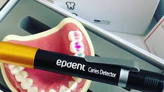 Кариес детектор Caries detector [upl. by Osy984]