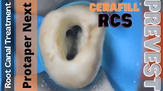 Root Canal Treatment in Maxillary Molar ⚪️ Protaper Next 🔵 Cerafill RCS Obturation [upl. by Eleda]