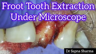 Front tooth got extracted UNDER A MICROSCOPE  Front Tooth Removal Procedure  Teeth Pulled Out [upl. by Khai]