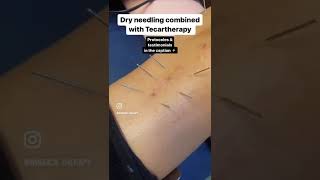 TECAR therapy combined with Dry Needling on a ACL postop ⚡ [upl. by Alyel139]