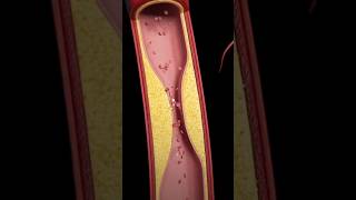 Atherosclerosis is a hardening of your arteries form plaque building biology relatable plauge [upl. by Mccormick]