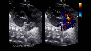 PATENT DUCTUS ARTERIOSUS LEFT HEART DILATION [upl. by Oniskey]