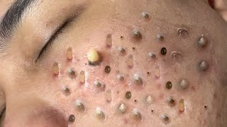 ACNE TREATMENT VU QUYNH MI Blackheads Removal Popping [upl. by Atiuqad]