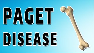 Pagets Disease [upl. by Eniamahs]