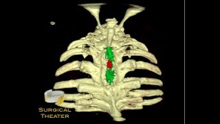 Ependymoma [upl. by Calendre]