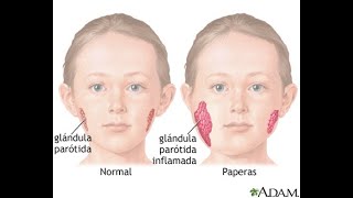 PAPERAS PAROTIDITIS CAUSAS SÍNTOMAS Y TRATAMIENTO [upl. by Yv]