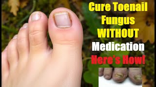 Toenail Fungus Cured Naturally Here’s the Secret [upl. by Hnahk240]