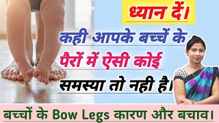 बच्चों के Bow Legs क्यों होते है और इससे कैसे बचाव करे उपाय। How To Cure Bow Legs In Babies [upl. by Eixor]