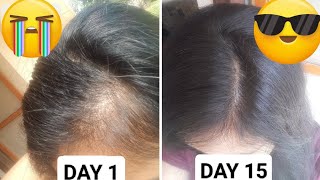 Foods to Stop Hair Loss – Ultimate Diet for Healthy Strong Hair [upl. by Drofyar]