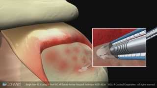 ConMed Linvatec Single Row Rotator Cuff Repair Using the Y Knot® RC Anchor Surgical Technique Anim [upl. by Kutzer]