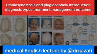 Craniosynestosis and plagiocephaly introduction diagnosis types treatment management outcome [upl. by Ojeillib427]