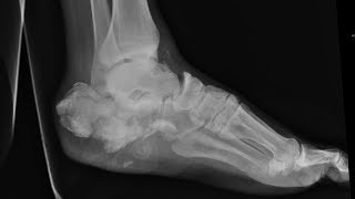 How to manage swelling amp pain post calcaneous fracture in young men of 20s Dr Mohan M R [upl. by Atiuqel362]