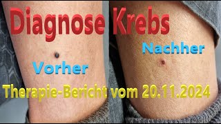 Diagnose KREBS  TherapieBericht vom 20112024 [upl. by Siriso599]