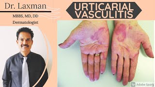 Urticarial Vasculitis  Vasculitis  Causes amp Symptoms amp Treatment Vasculitis Allergy Dermatology [upl. by Wisnicki]