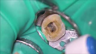 One G One Flare and One Curve The way of simplified root canal treatment [upl. by Enirac419]