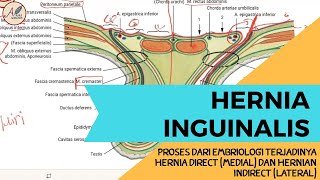 Hernia Inguinal  Hernia Direct Medial dan Hernia Indirect Lateral [upl. by Ladew]