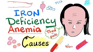 Iron Deficiency Anemia  Causes  Hematology Series [upl. by Yrakcaz]