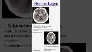 Subarachnoid hemorrhage vs intracerebral hemorrhage  viralvideo hemorrhage [upl. by Kate777]