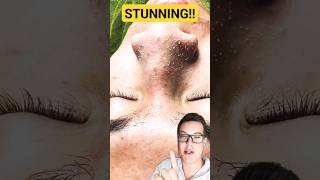 ULTIMATE PORE STRIP REMOVAL  How To Prep Skin For Pore Strips shorts [upl. by Duj]