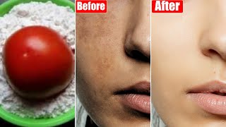 I rubbed this just 3 times amp I was Shocked😱झाइयाँ Pigmentation Spots सब ख़त्मGet Fair Skin Naturally [upl. by Rehpoitsirhc675]