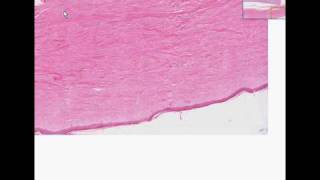 Histopathology Skin kidney Systemic sclerosis scleroderm [upl. by Aziram]