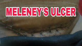 MELENEYS ULCER [upl. by Sella669]