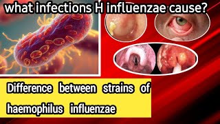 Haemophilus influenzae  Microbiology  What is the difference between strains bacteria [upl. by Ludba270]