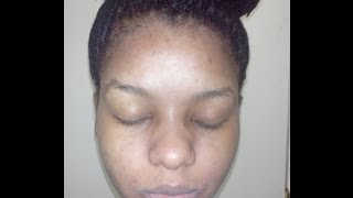 How kojic acid soap changed my face week 4 before and after pictures [upl. by Kreindler434]