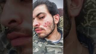 30 Din Mein Acne Gayab Acnestar Gel  I Used Acnestar Gel 30 Days Acne Transformation shorts acne [upl. by Naujej]