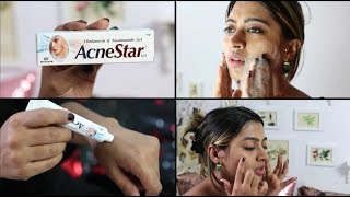 Acnestar Gel Review  HOW TO REALLY GET RID OF ACNE  SuperWowStyle Prachi [upl. by Bluhm]