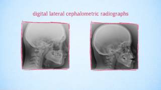 Infographic  Craniofacial growth and hypodontia in Down Syndrome [upl. by Waylen738]