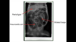 Paediatrics  complications of prematurity [upl. by Yaya708]