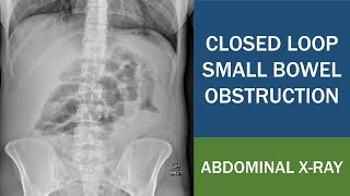 Closed Loop Small Bowel Obstruction Post Laparoscopic Rectopexy  Titanium Surgical Tacks [upl. by Aleras910]