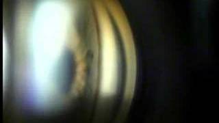 Yag Laser Trabeculoplasty for Glaucoma [upl. by Alekram]